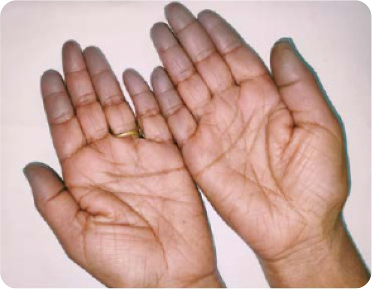 Prevalence of Anti-Synthetase Syndrome in Patients of Interstitial Lung Disease with Connective Tissue Diseases and Autoimmune Features: A Cross-Sectional Study.