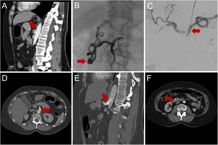 Interventional treatment of peripancreatic aneurysms: can one strategy fit all?