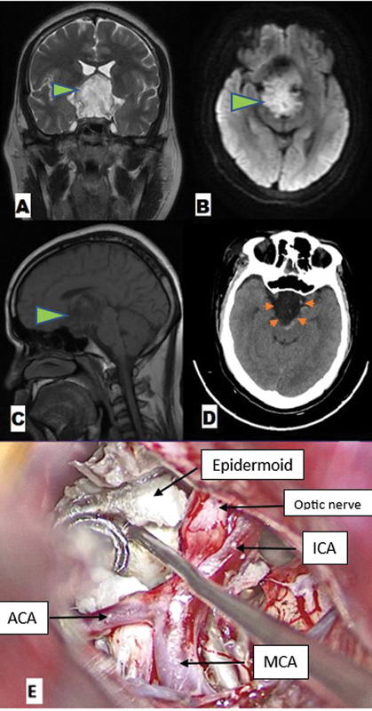 Exoscopic Supraorbital Keyhole Approach for Skull Base Lesions: An Institutional Experience.