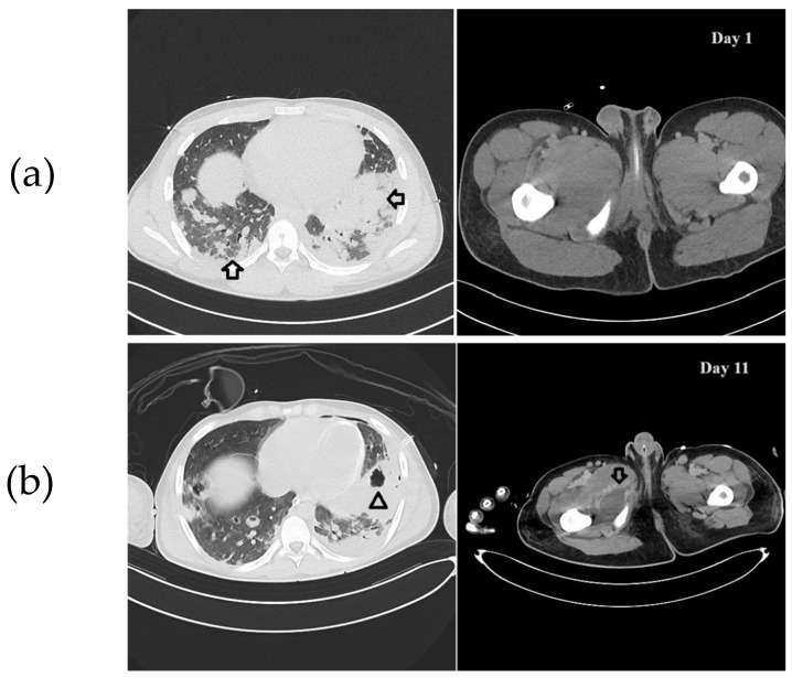 Effective Management of a Skin and Soft Tissue Infection Caused by Community-Acquired MRSA Through Triple-Targeted Therapy Along with Aggressive Source Control: A Case Report.