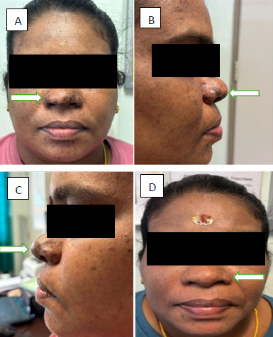 Unmasking the chik sign: A case report on nasal hyperpigmentation as a diagnostic clue for chikungunya fever.