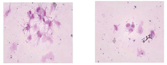 [Brain and Meningeal Metastases of Lung Cancer Manifested as Brain Calcifications:  A Case Report and Literature Review].