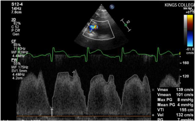 Serial echocardiography in preterm infants with bronchopulmonary dysplasia: diagnosing and managing recurrent pulmonary vein stenosis.