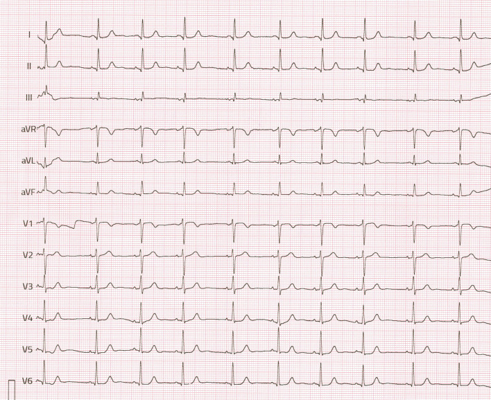Lipomatous Hypertrophy of the Interatrial Septum.