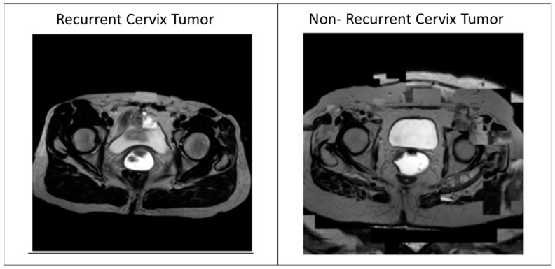 Discussion of a Simple Method to Generate Descriptive Images Using Predictive ResNet Model Weights and Feature Maps for Recurrent Cervix Cancer.