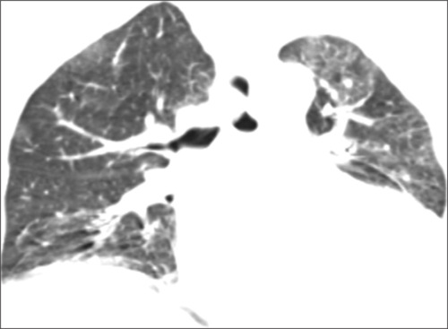 Diffuse Pulmonary <sup>99m</sup>Tc-MDP Uptake on Bone Scintigraphy: A Paraneoplastic Hypercalcemia Clue in Cervical Carcinoma.