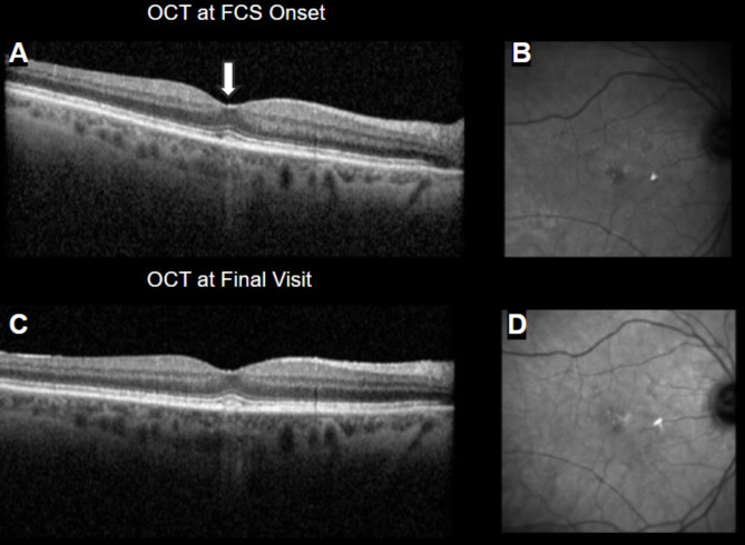 Foveal crack sign and macular pattern dystrophy.