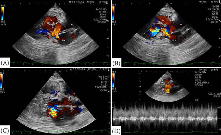 Cor triatriatum sinister with partial atrioventricular septal defect in a cat.