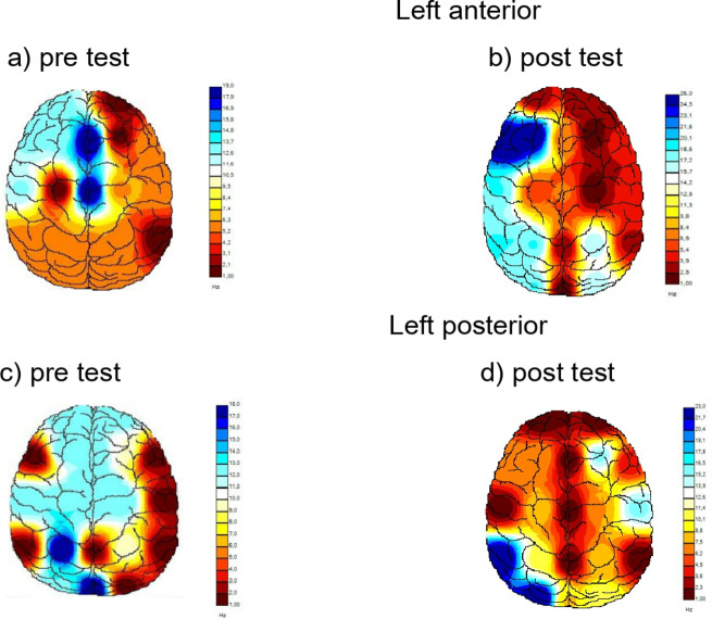 Transcranial direct current stimulation associated with physical exercise can help smokers to quit smoking: a randomized controlled trial.
