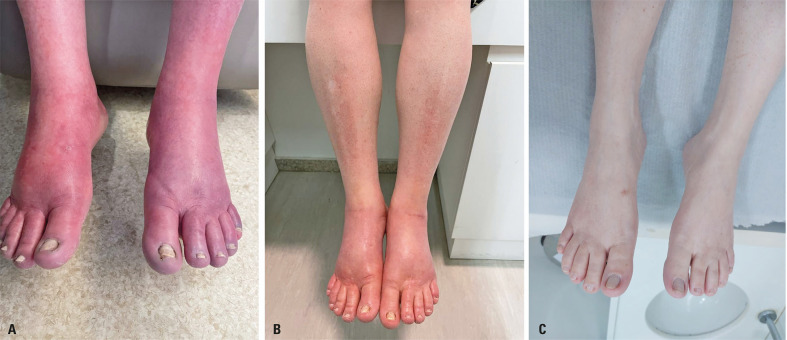 Intravenous immunoglobulin therapy in erythromelalgia management: a case report.