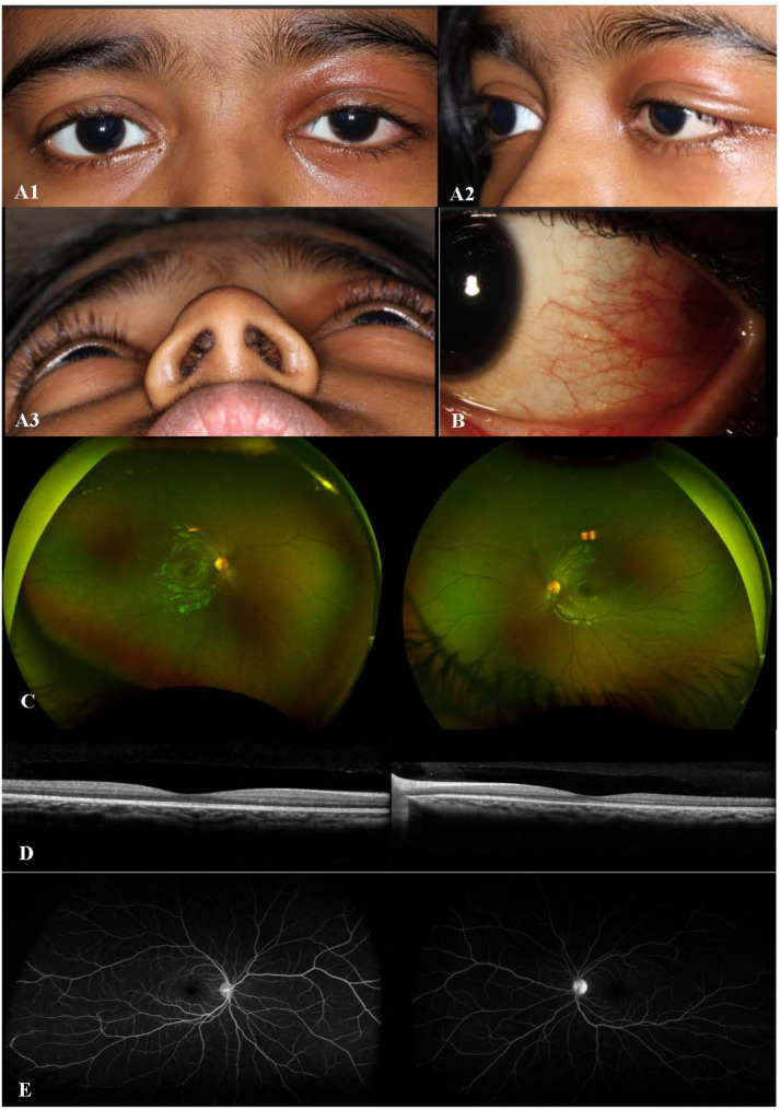 IgG4-related ophthalmic disease presenting as posterior scleritis in a pediatric patient.