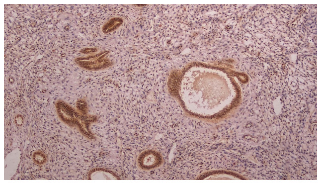 Impact of sirtuin‑1 expression on progression‑free survival in non‑endometrioid endometrial cancer: A retrospective cohort study.