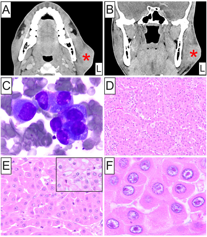Oncocytic Mucoepidermoid Carcinoma of the Parotid Gland.