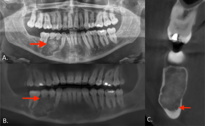 Mandibular Cemento‑ossifying Fibroma.