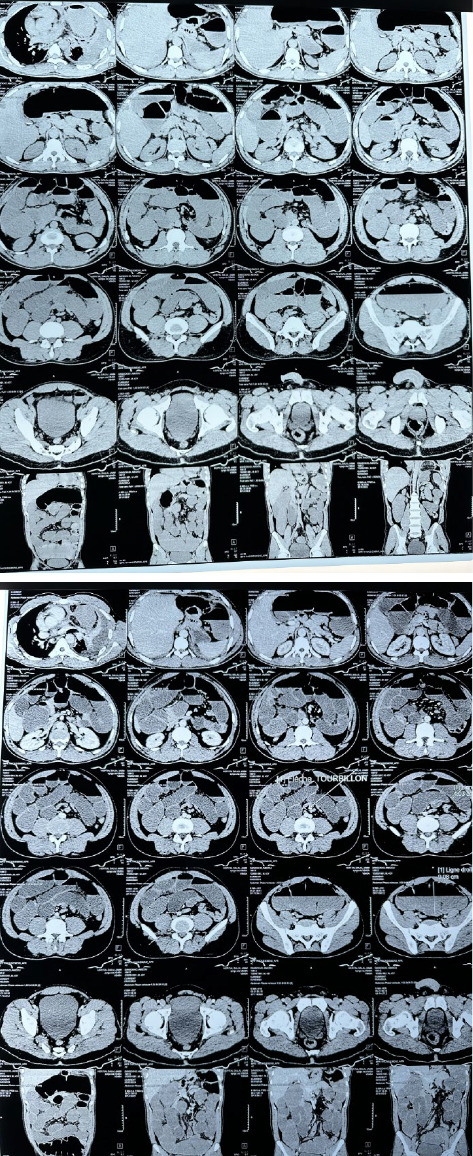 Post-Traumatic Diaphragmatic Hernia Presenting as Bowel Obstruction 12 Years After a Chest Gunshot Wound: A Rare Delayed Diagnosis.