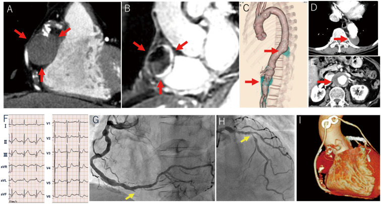 Vascular Behcet's Syndrome　- A Giant Coronary Artery Aneurysm, Recurring Aortic Aneurysms and Prior History of Acute Myocardial Infarction.