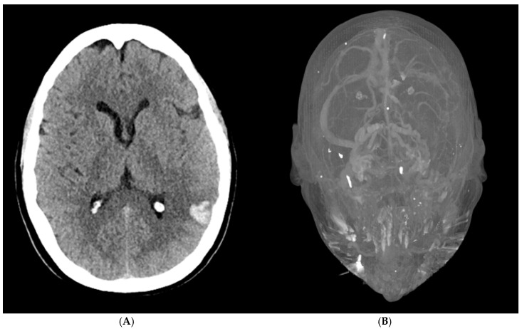 Acute Intracerebral Hemorrhage Associated with Extensive Venous Thrombosis Due to Spontaneous Heparin-Induced Thrombocytopenia After Total Knee Replacement: A Case Report.