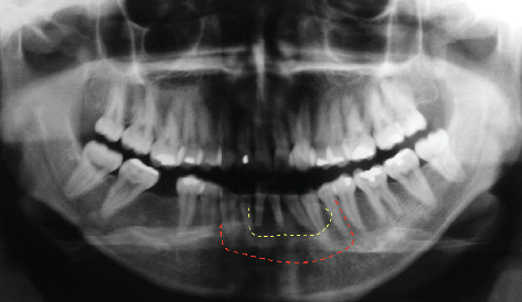 Fifteen-Year Follow-Up: Treatment of Recurrent Mandibular Giant Cell Lesion-From Resection to Rehabilitation.
