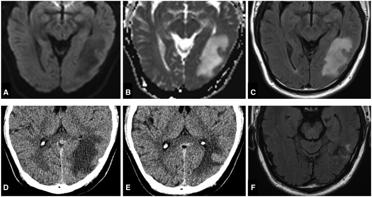 Unexpected vasogenic oedema and alexia as complications after dural arteriovenous fistula embolization.