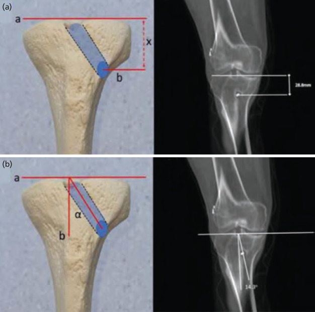 Morphometric Analysis of the Tibial Tunnel after Primary and Revision Anterior Cruciate Ligament Reconstruction.