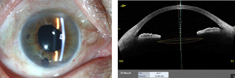 The Suture-In-Needle, Closed-Loop Technique for Repositioning a Dislocated Akreos Adapt Intraocular Lens.