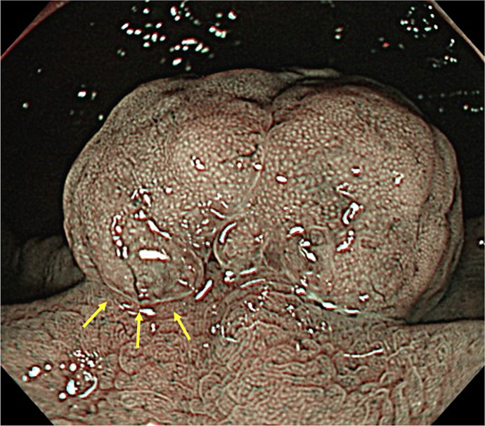 Step-Down Therapy Using Vonoprazan for Giant Gastric Polyps in Long-Term Proton Pump Inhibitor Administration.