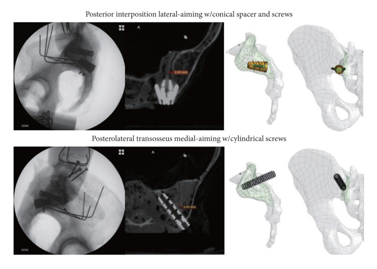 Fixation of the Sacroiliac Joint: A Cadaver-Based Concurrent-Controlled Biomechanical Comparison of Posterior Interposition and Posterolateral Transosseous Techniques.