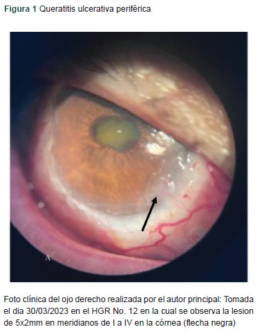 [Peripheral ulcerative keratitis with necrotizing scleritis, manifestation of granulomatosis with polyangiitis].