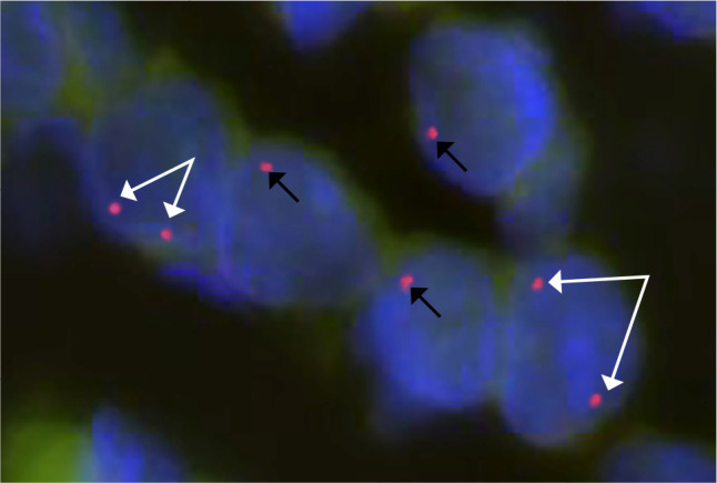 Placental insufficiency irrespective of offspring karyotype in maternal Turner syndrome: a case series and literature review.
