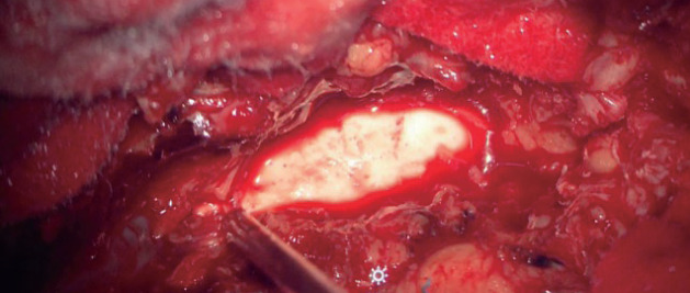 Cement-Augmented Pedicle Screw Fixation in Patients with Osteoporosis : Safety, Efficacy and Complications.