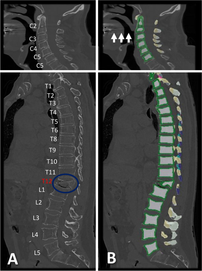 Cervicothoracic volumetric bone mineral density assessed by opportunistic QCT may be a reliable marker for osteoporosis in adults.
