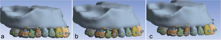 Stress Distribution and Tooth Displacement Analysis of Maxillary Molar Distalization by Different Designs of Jig in a Finite Element Study.
