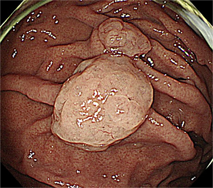 Step-Down Therapy Using Vonoprazan for Giant Gastric Polyps in Long-Term Proton Pump Inhibitor Administration.