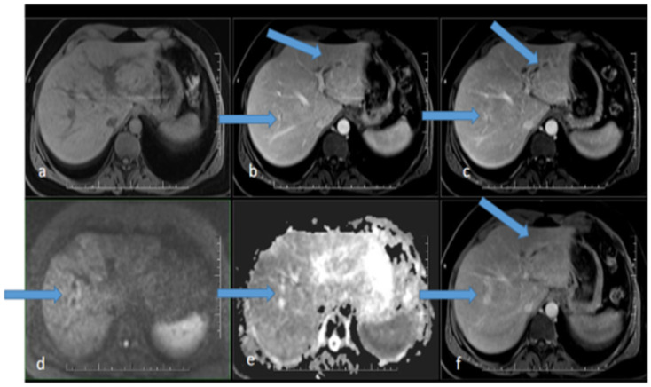 Syphilitic Cholangiopathy Mimicking Primary Sclerosing Cholangitis.