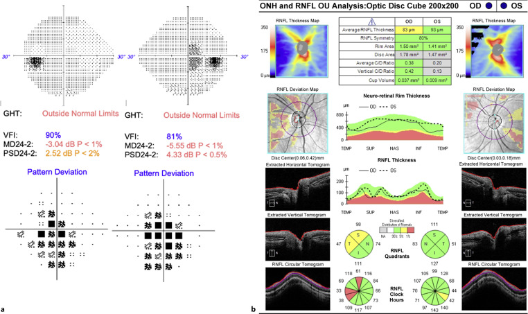 DNAJC30 Mutation in a Patient with Coexisting Leber's Hereditary Optic Neuropathy and Multiple Sclerosis (Harding's Syndrome): A Case Report.