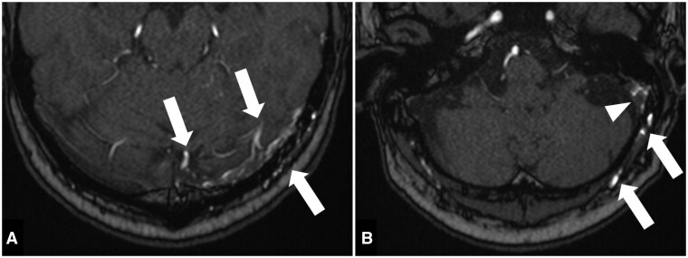 Unexpected vasogenic oedema and alexia as complications after dural arteriovenous fistula embolization.