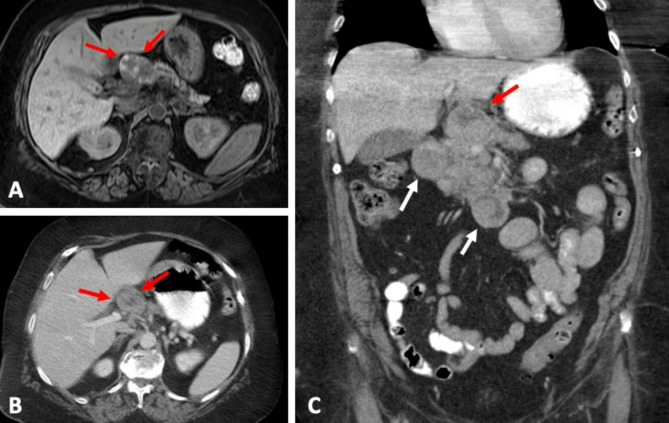 Acinar cell carcinoma of the pancreas: can CT and MR features predict survival?