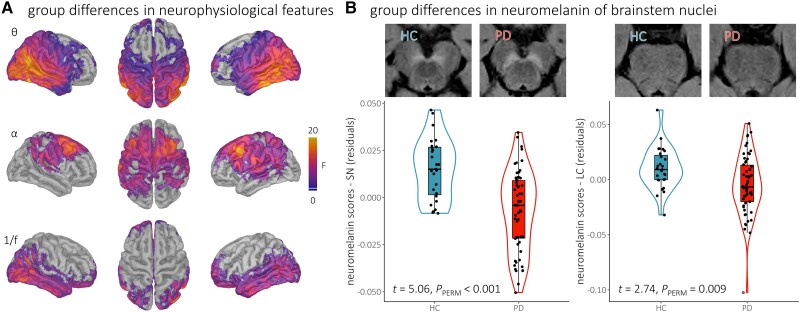 Associations between neuromelanin depletion and cortical rhythmic activity in Parkinson's disease.