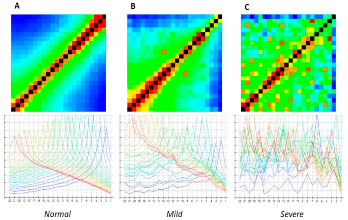 A Novel Trans-Impedance Matrix (TIM) Abnormality Pattern in Cochlear Implants.