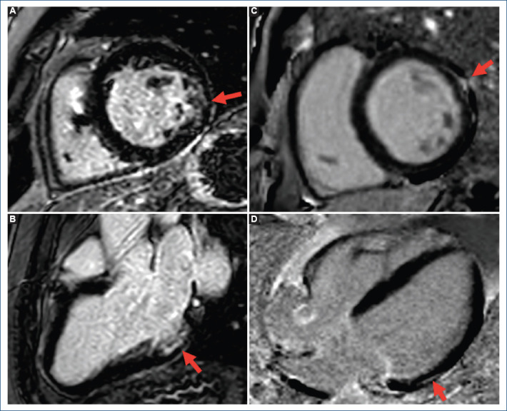[Dilated cardiomyopathy and conduction disorder due to <i>TNNI3K</i> mutation].