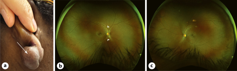 Ipsilateral, Multi-Phasic Retinal Vascular Events following Intralesional Triamcinolone Acetonide Injection for Earlobe Keloid: A Case Report.