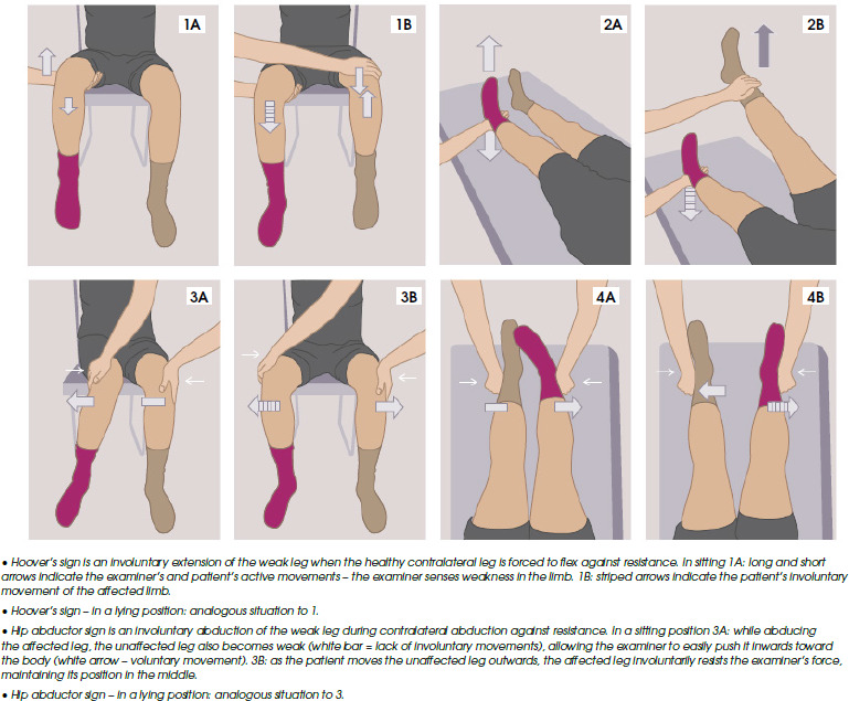 Intravenous tissue plasminogen activator in functional stroke mimics.