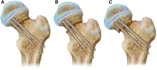 Management of pediatric femoral neck fractures from classification to surgery: a review of indications based on anatomic and radiographic features of the proximal femur.