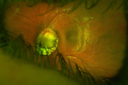 Optic Nerve Coloboma in a Child With Compound Heterozygous USH2A Variants.