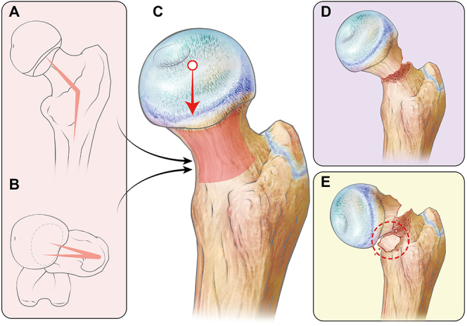 Management of pediatric femoral neck fractures from classification to surgery: a review of indications based on anatomic and radiographic features of the proximal femur.