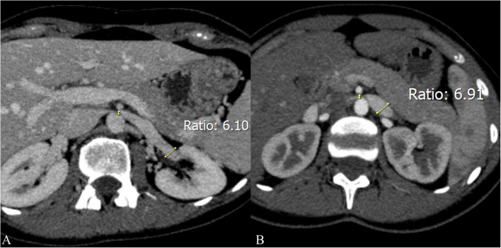 Controversies in treating nutcracker syndrome.