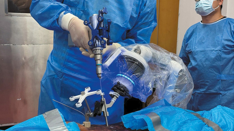 Percutaneous endoscopic lumbar partial laminectomy assisted by a new miniature parallel surgical robot system: a trial on a cadaveric specimen.