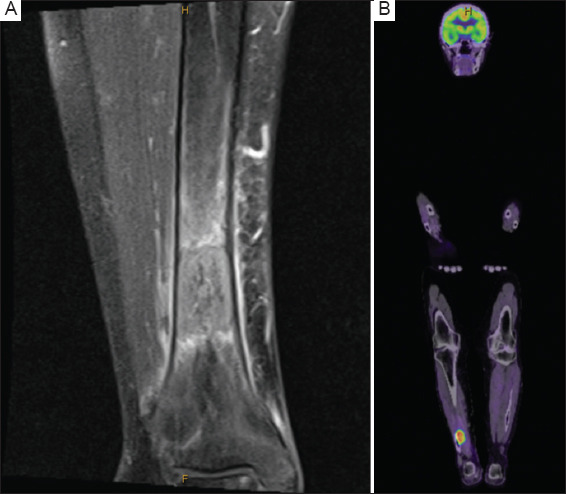 An unusual distal tibial metastasis from urothelial carcinoma: A case report.