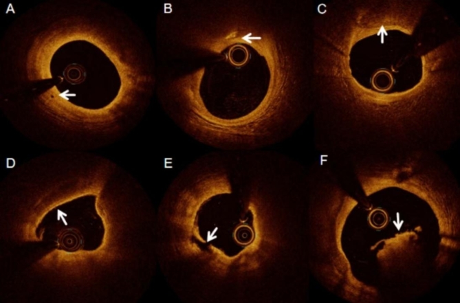 Clinical characteristics and prognosis of myocardial infarction with nonobstructive coronary arteries evaluated by optical coherence tomography.
