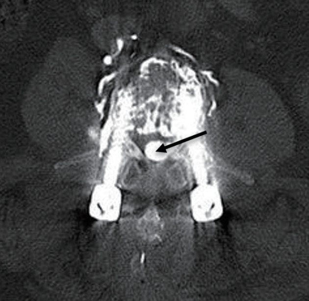 Cement-Augmented Pedicle Screw Fixation in Patients with Osteoporosis : Safety, Efficacy and Complications.